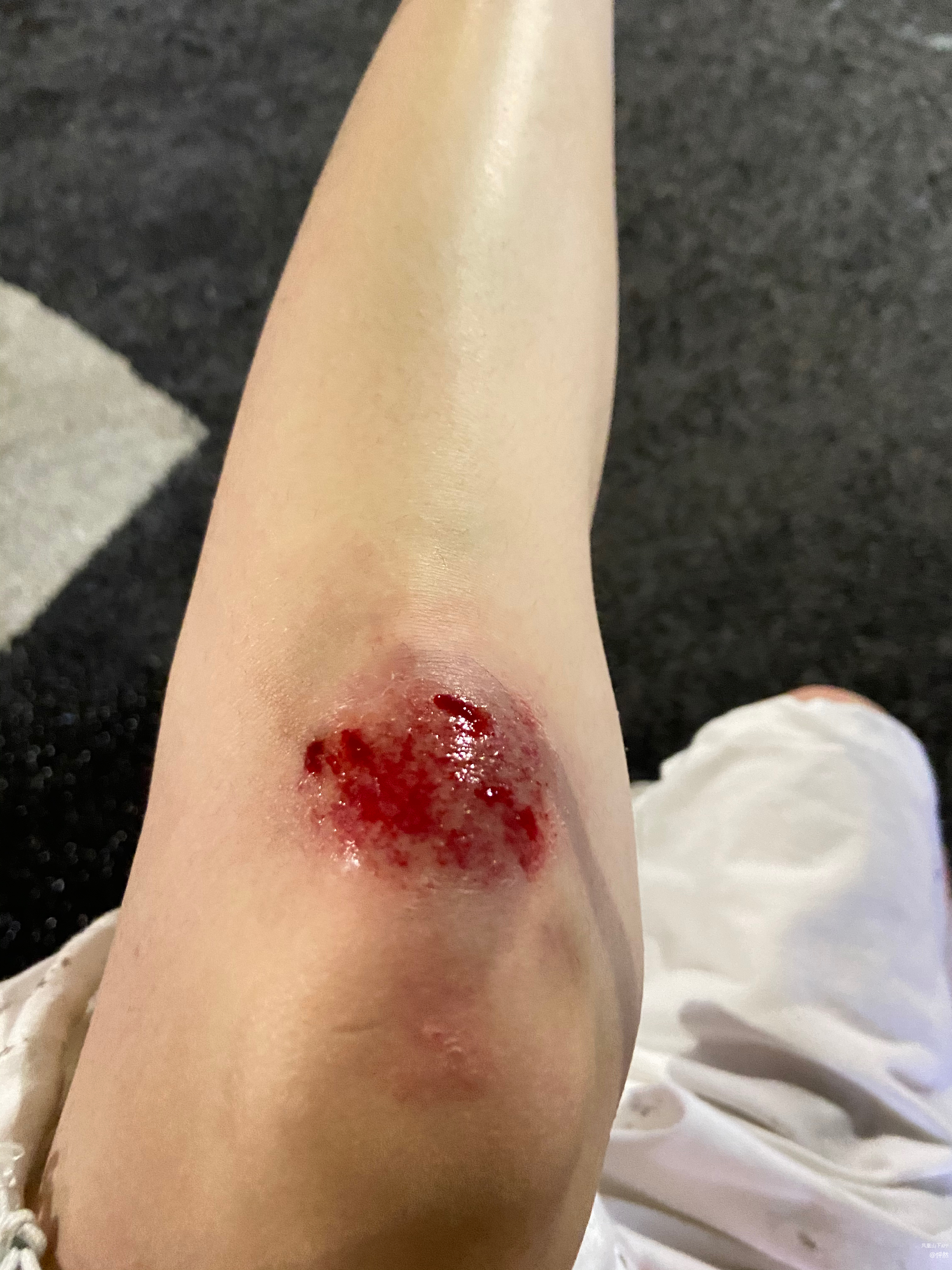 因为道路损坏有坑洼 导致骑车摔倒 - 今日达州 - 凤